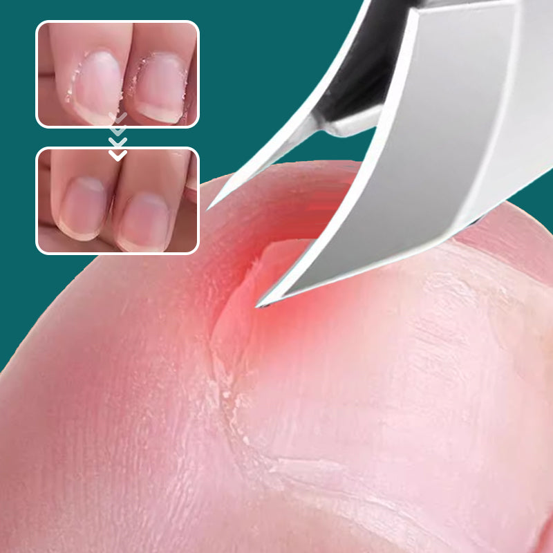 📢50 % RABATT!✨💅 Nagelpflege-Set für dicke & eingewachsene Nägel – Präzision & Langlebigkeit in einem! ✨