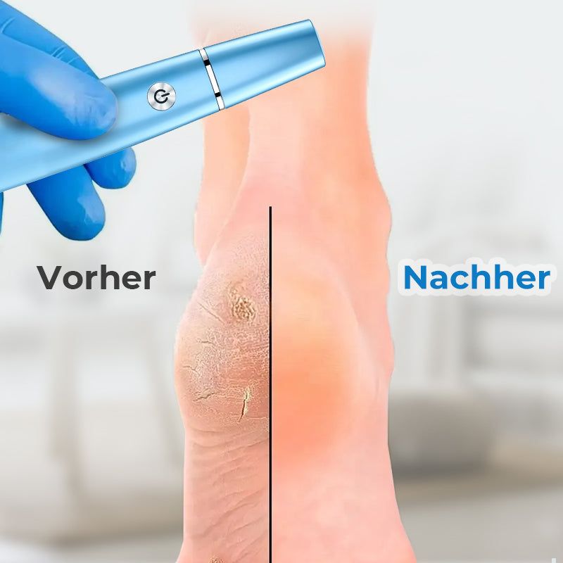 ⏳Begrenzte Zeit 46% Rabatt💥Elektrischer Hornhautentferner für die Füße
